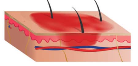 neurodermitis